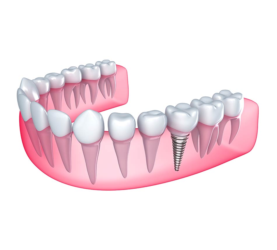 Single dental implant in Lexington - Schroeder Cosmetic & Family Dentistry