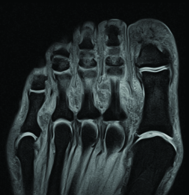 MRI scan showing detailed bone structure of the toes and metatarsal bones in a human foot.