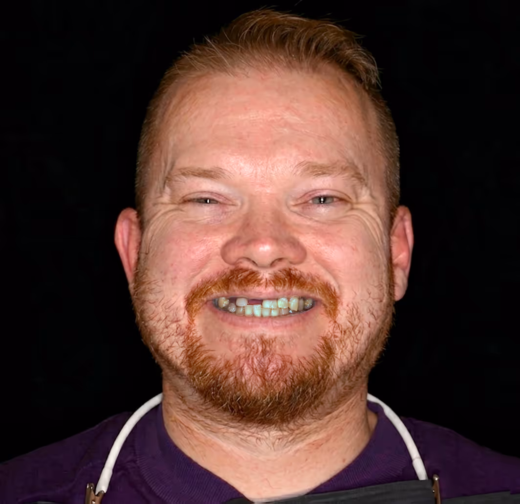 Smiling man with red hair and beard showing teeth with some discoloration and gaps.