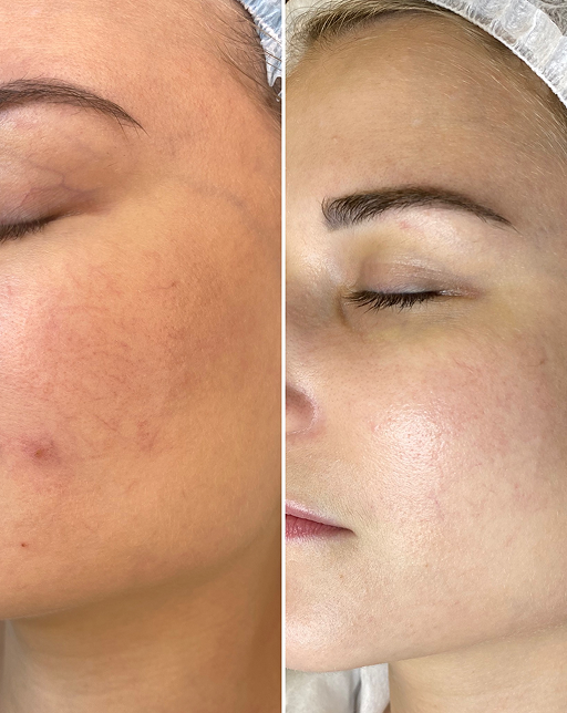 Side-by-side comparison of a woman's face showing skin before and after treatment with clearer and smoother skin on the right side.