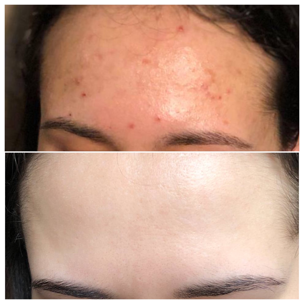 Comparison of a forehead before and after acne treatment, showing red acne spots in the top image and clear, smooth skin in the bottom image.