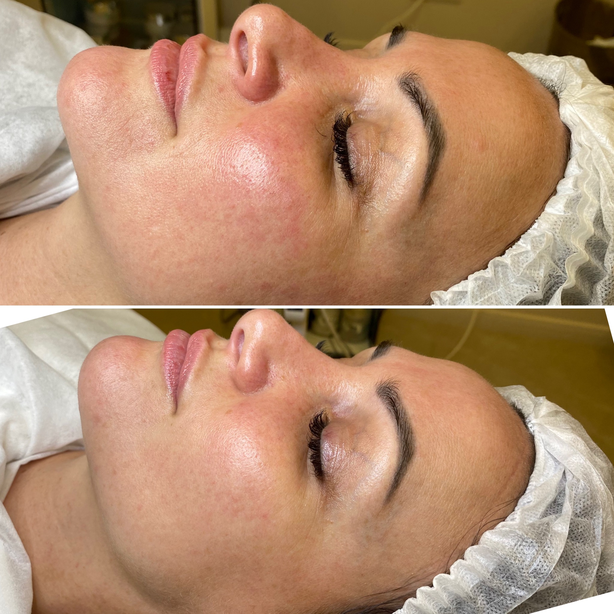 Side-by-side images showing a woman's face before and after treatment, with reduced redness and smoother skin tone on the right.