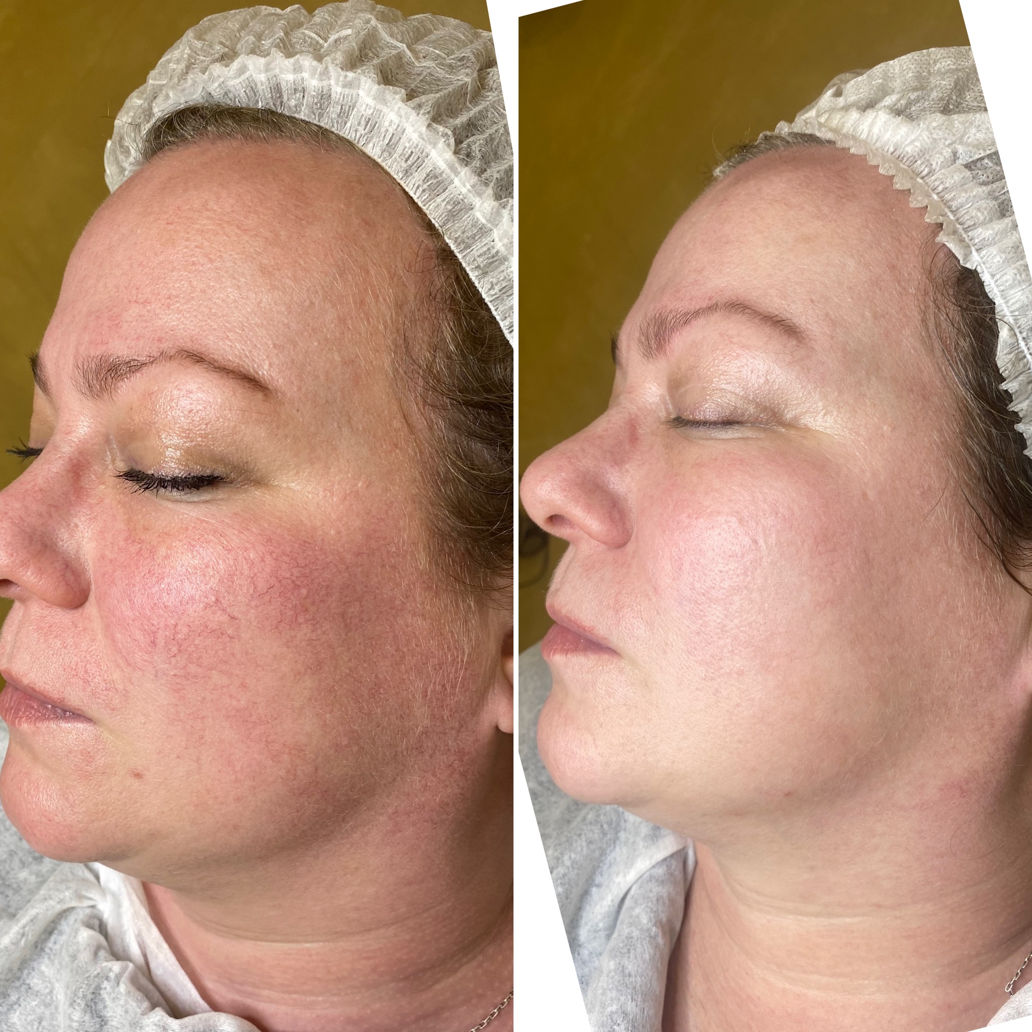 Before and after skincare treatment showing a woman’s cheek with acne and redness greatly reduced and skin appearing smoother and clearer.