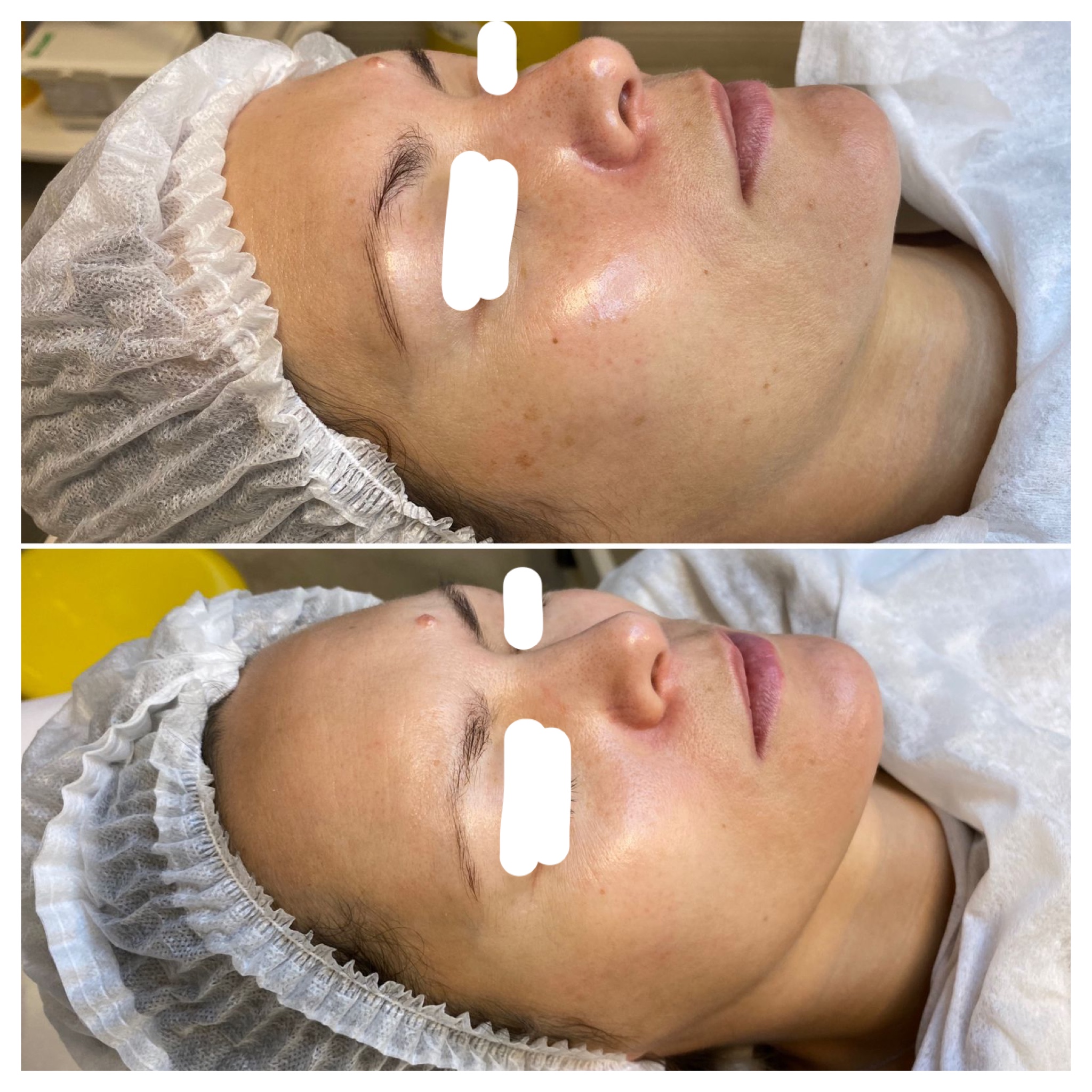 Side-by-side comparison of a woman's face before and after skincare treatment showing reduced redness and smoother skin texture.