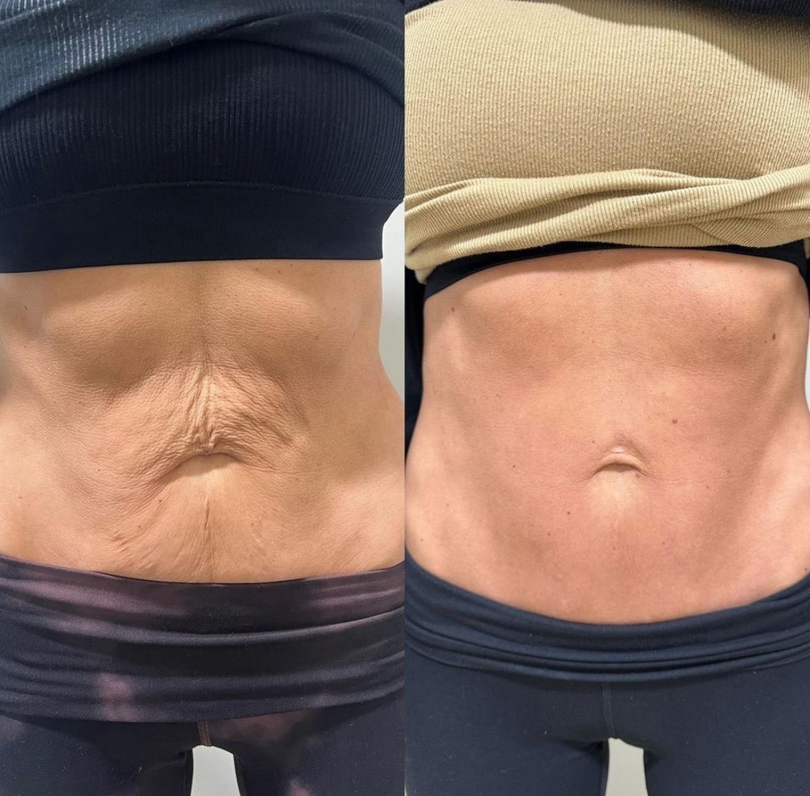 Before and after result 1