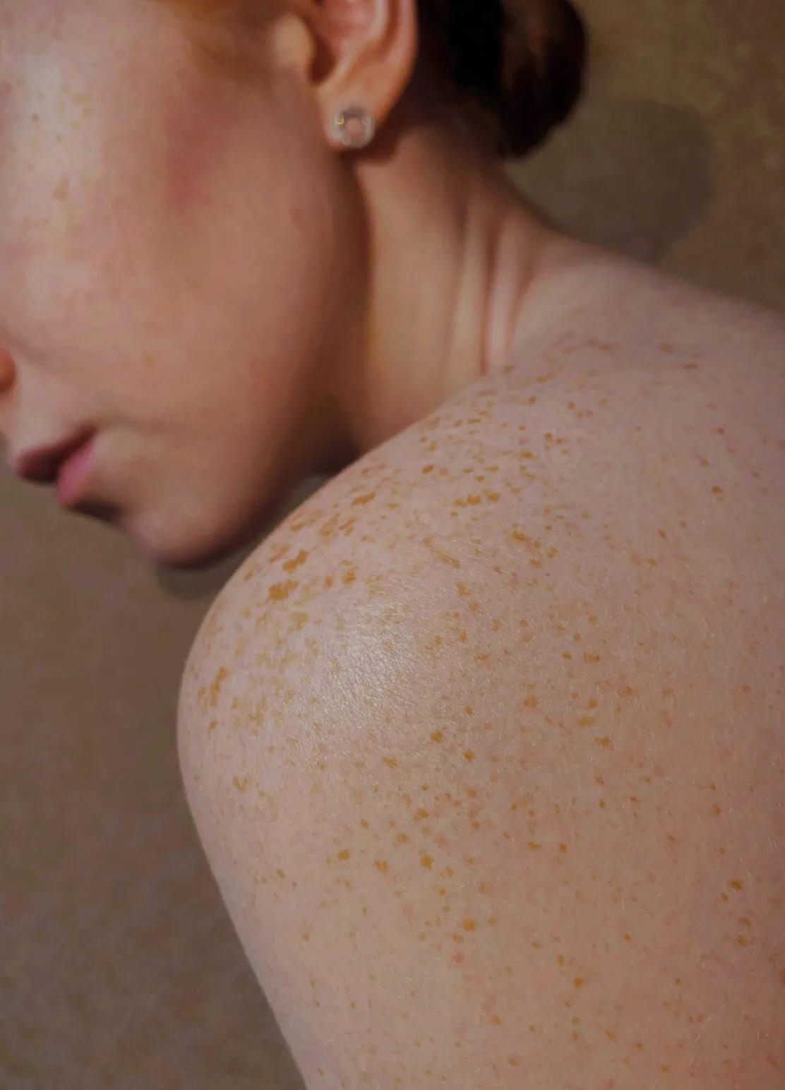 Hautarzt Oberland - Pigmentflecken, Tattoos, Permanent Make-up