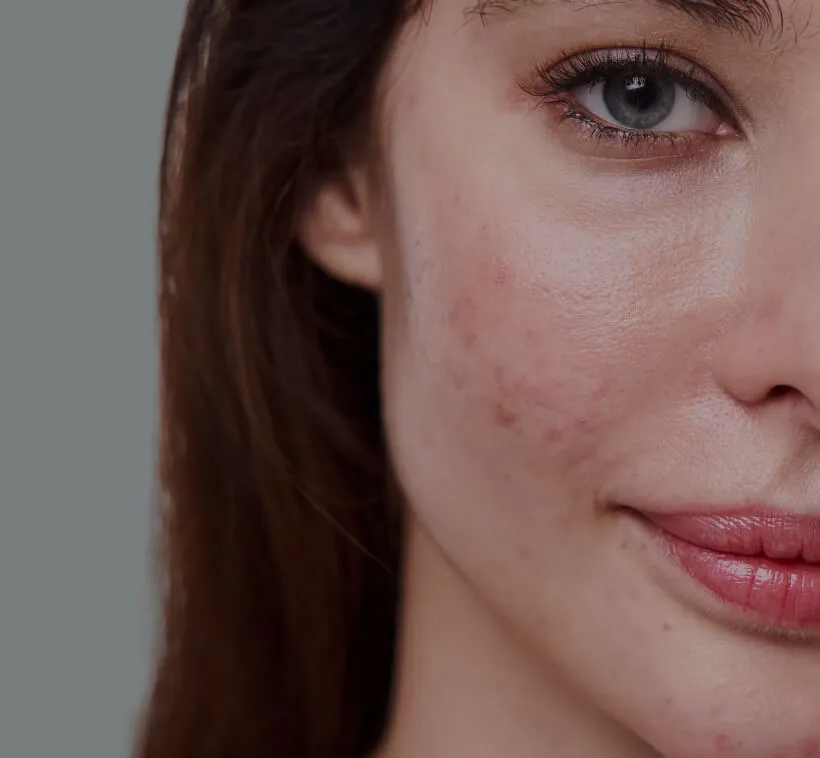 Hautarzt Oberland - Akne und Rosacea
