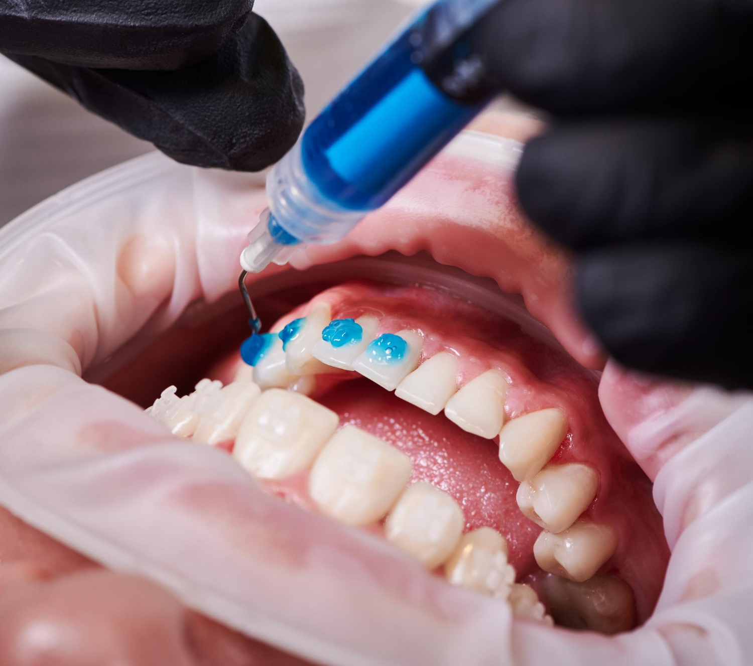 Dentist wearing gloves applying blue dental etching gel to upper teeth inside an open mouth.