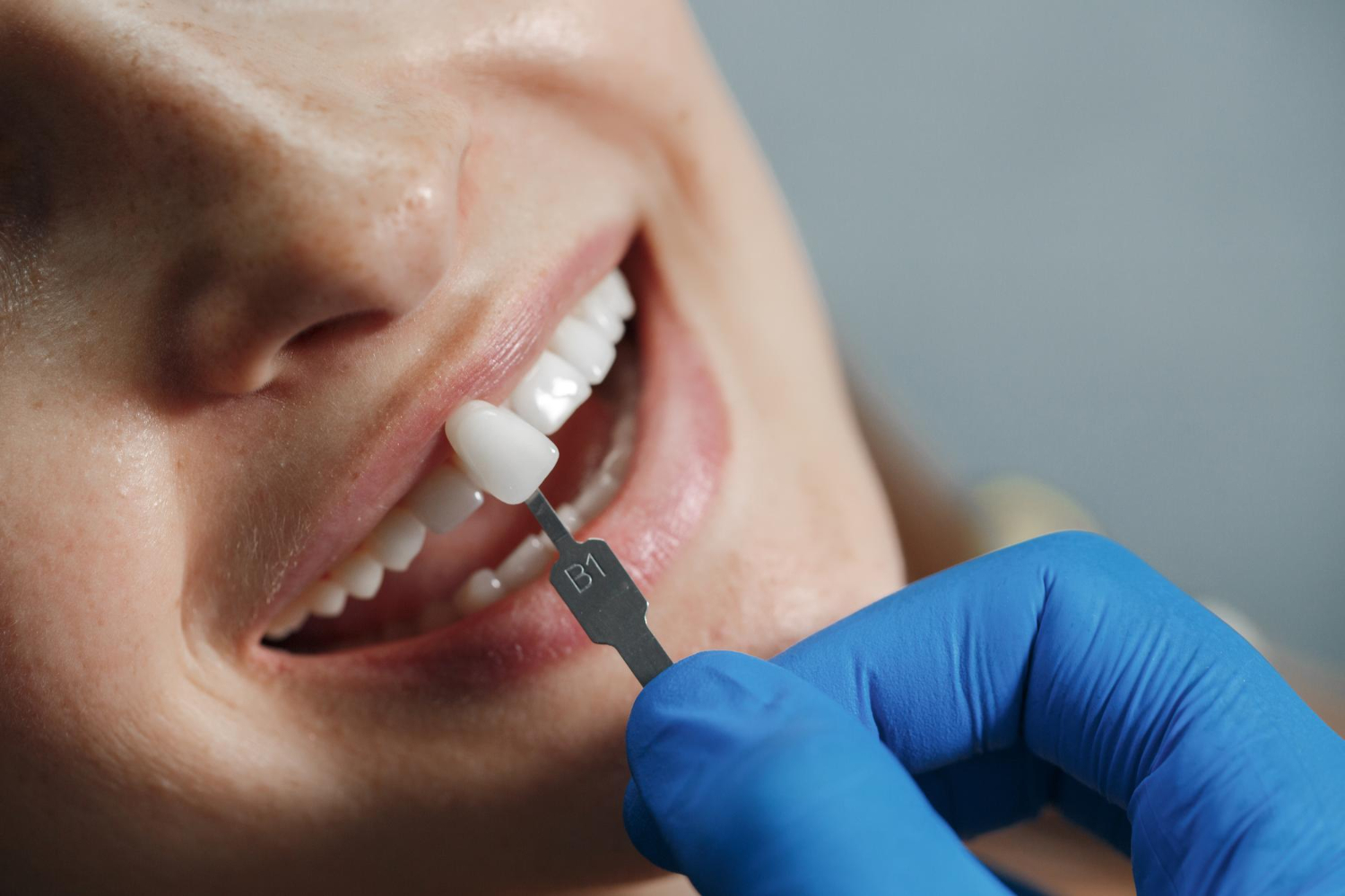 Close-up of a dental professional wearing blue gloves matching a B1 shade tooth veneer to a smiling patient's upper teeth.