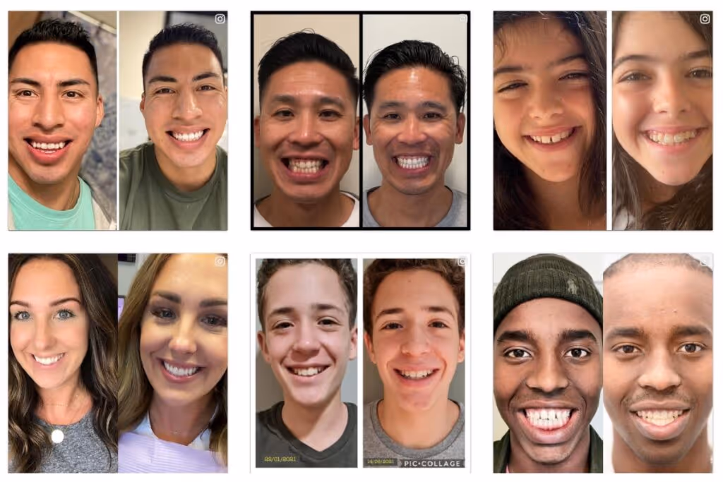 Invisalign Before and After images of 6 customers