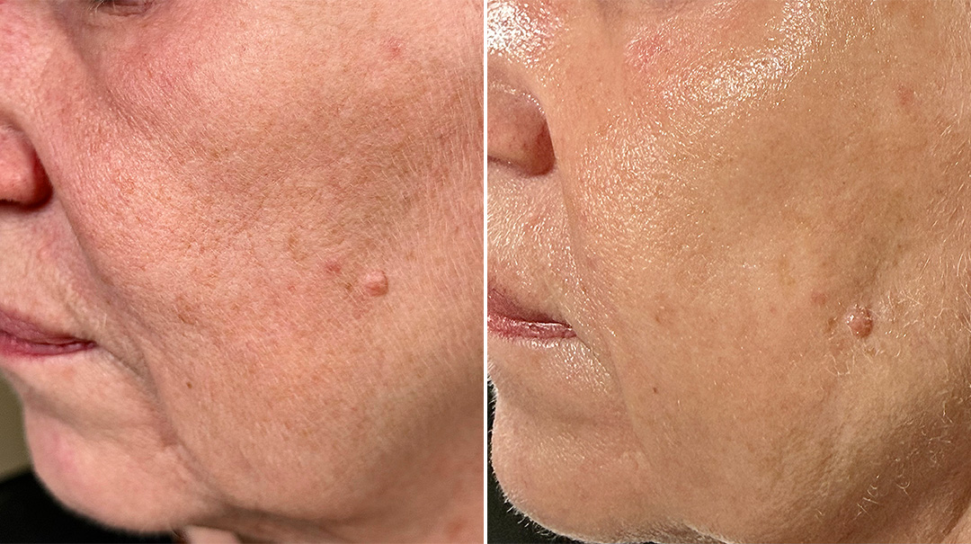 futuracontour_beforeandafter