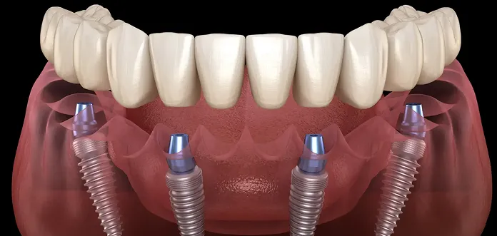 3D illustration of a dental implant-supported denture with four metal implants anchored into the lower jawbone.