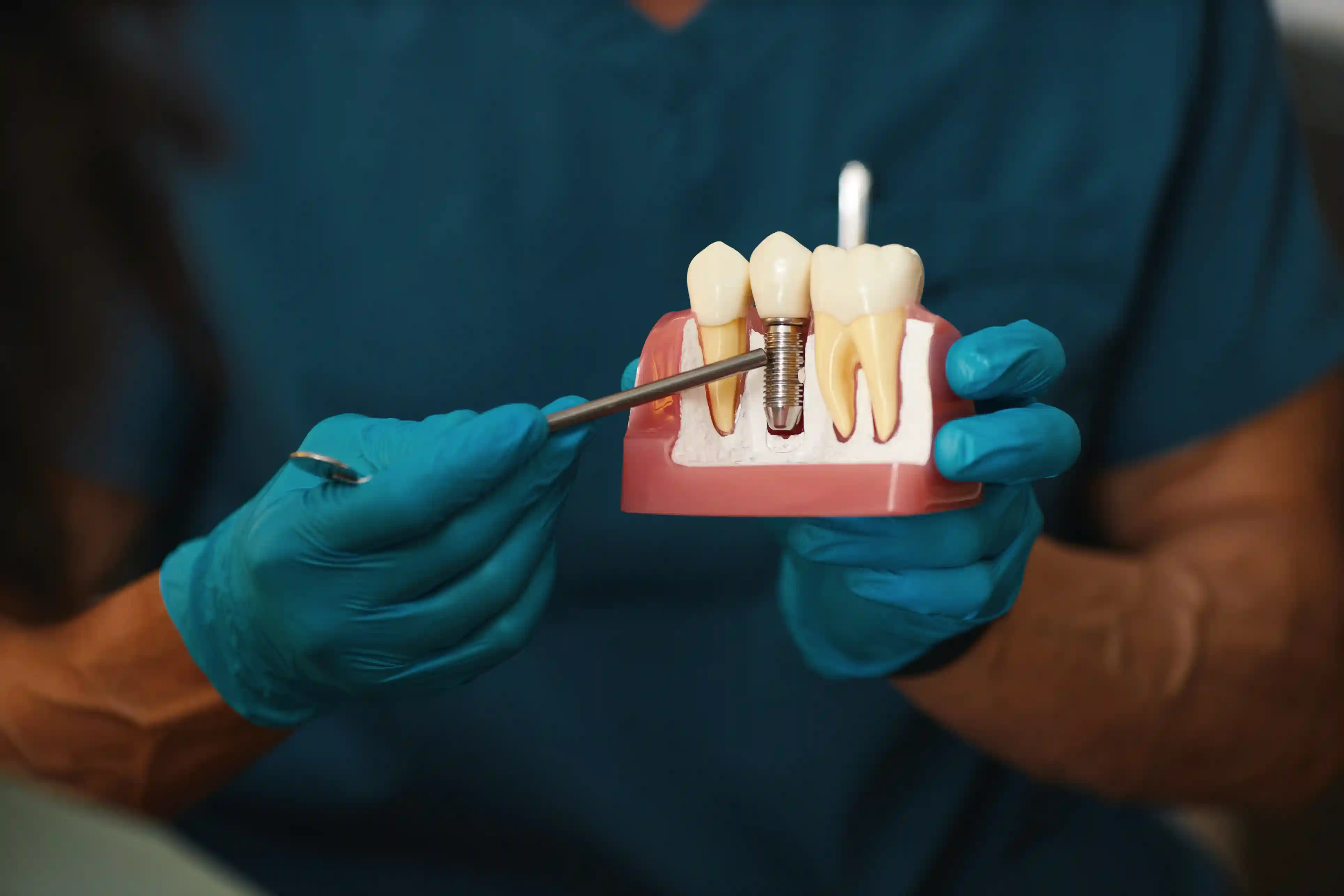 3D illustration of a dental implant showing the crown being placed on the metal abutment and screw within gums among natural teeth.