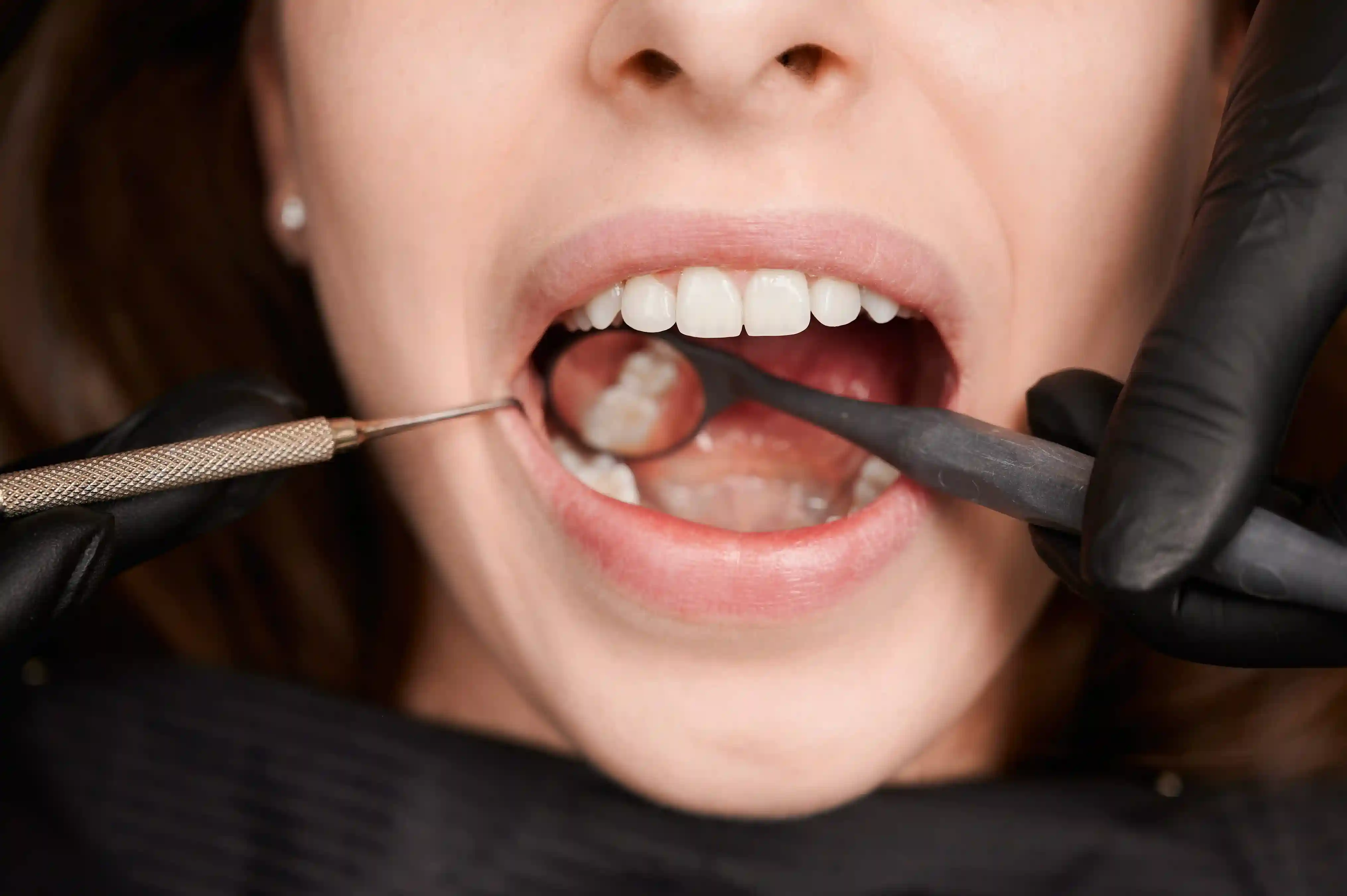 3D illustration of a dental implant with a crown being positioned above the metal abutment inside the gums.