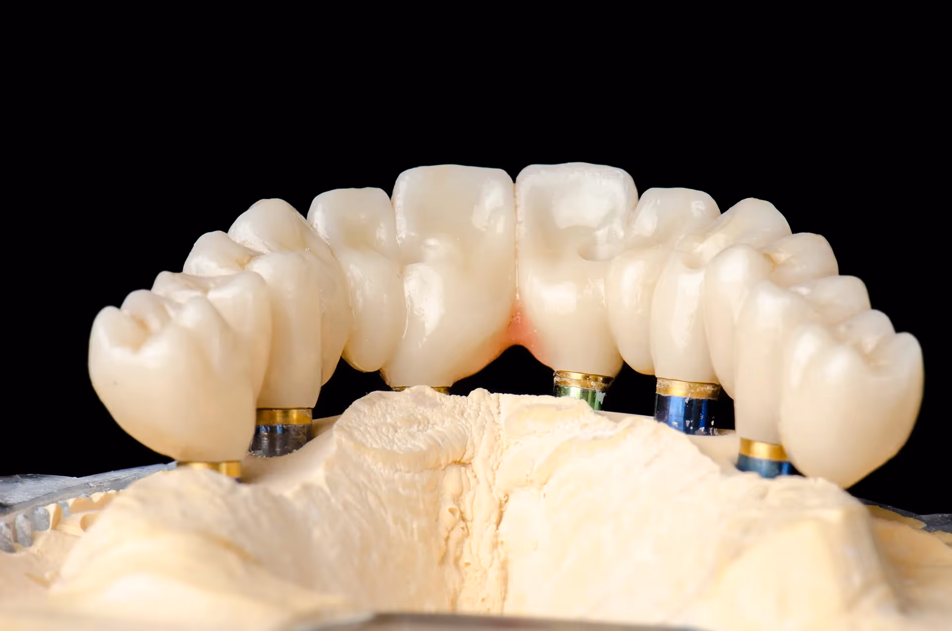 All-on-X Implants in Charlotte, NC