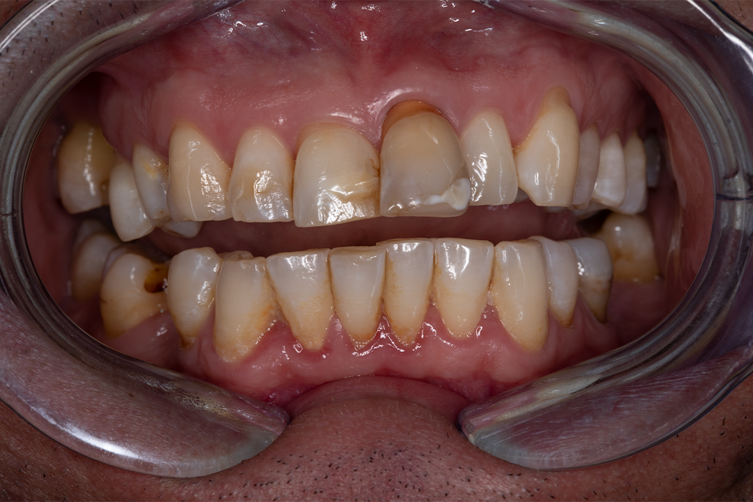 discoloured teeth