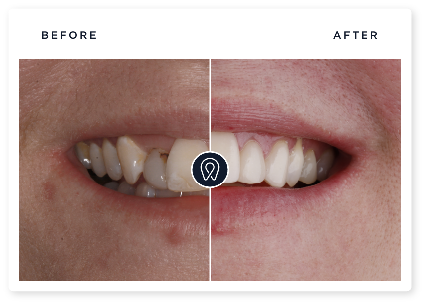 porcelain veneers before and after