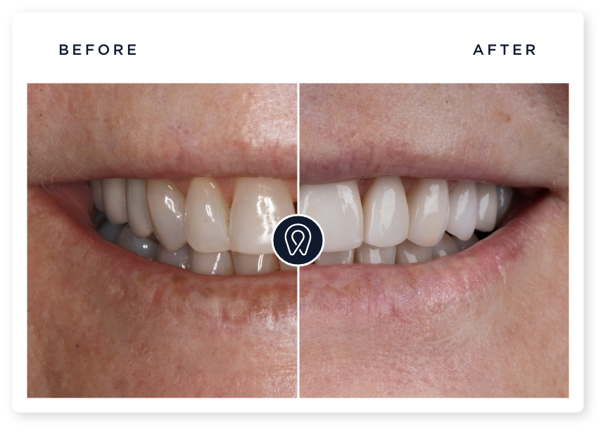 porcelain veneers before and after