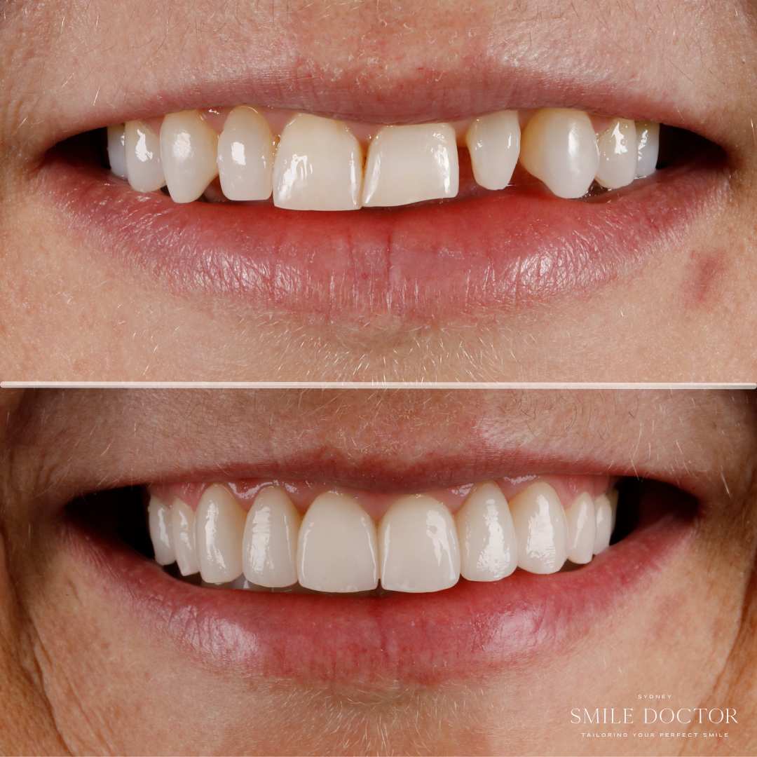 Porcelain Veneers, Sydney Smile Doctor Penrith