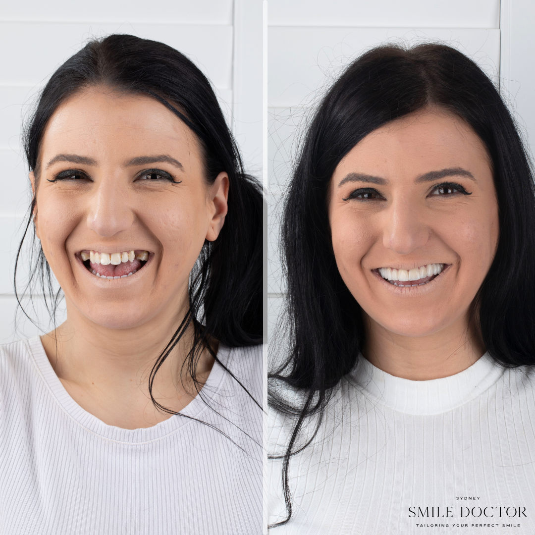 Full smile makeover before and after, Sydney Smile Doctor Penrith.