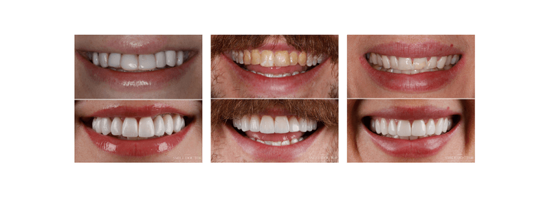 Before and after veneers results, Sydney Smile Doctor Penrith patients.