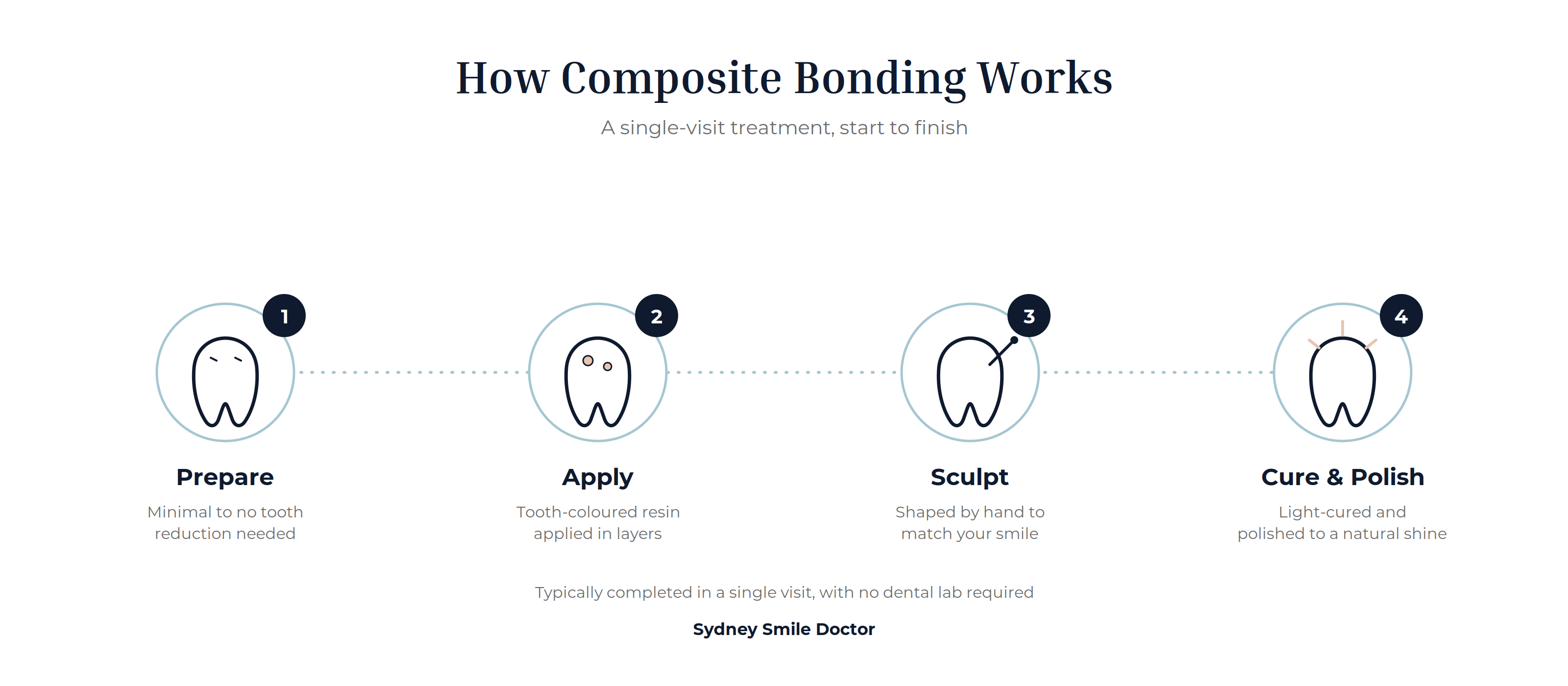 Diagram showing the four steps of composite bonding: prepare, apply, sculpt, and cure and polish