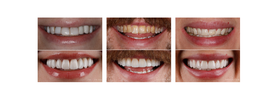 Before and after porcelain veneers smile makeover result, Sydney Smile Doctor Penrith