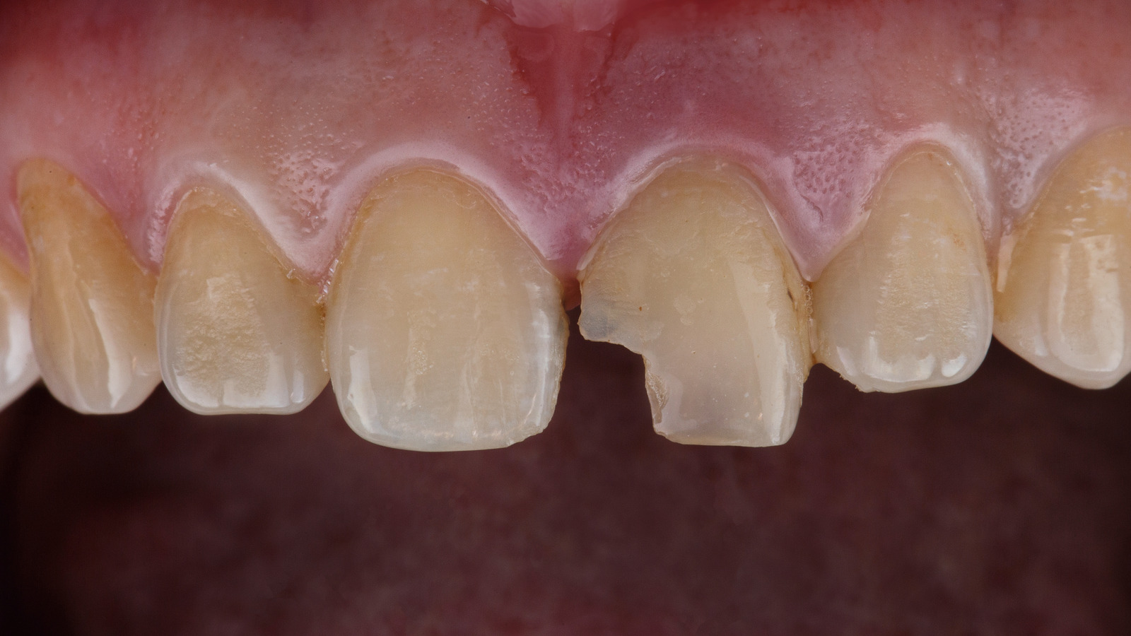 Clinical close-up photo showing six upper front teeth and gums. The left central incisor has a large chip missing from its lower right edge, exposing a rough surface. Teeth show natural discoloration.