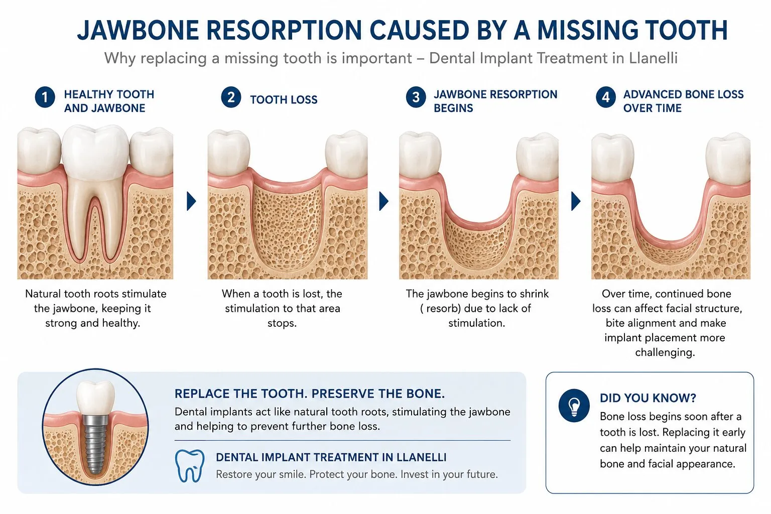 Diagram showing jawbone resorption caused by a missing tooth, relevant to dental implant treatment in Llanelli