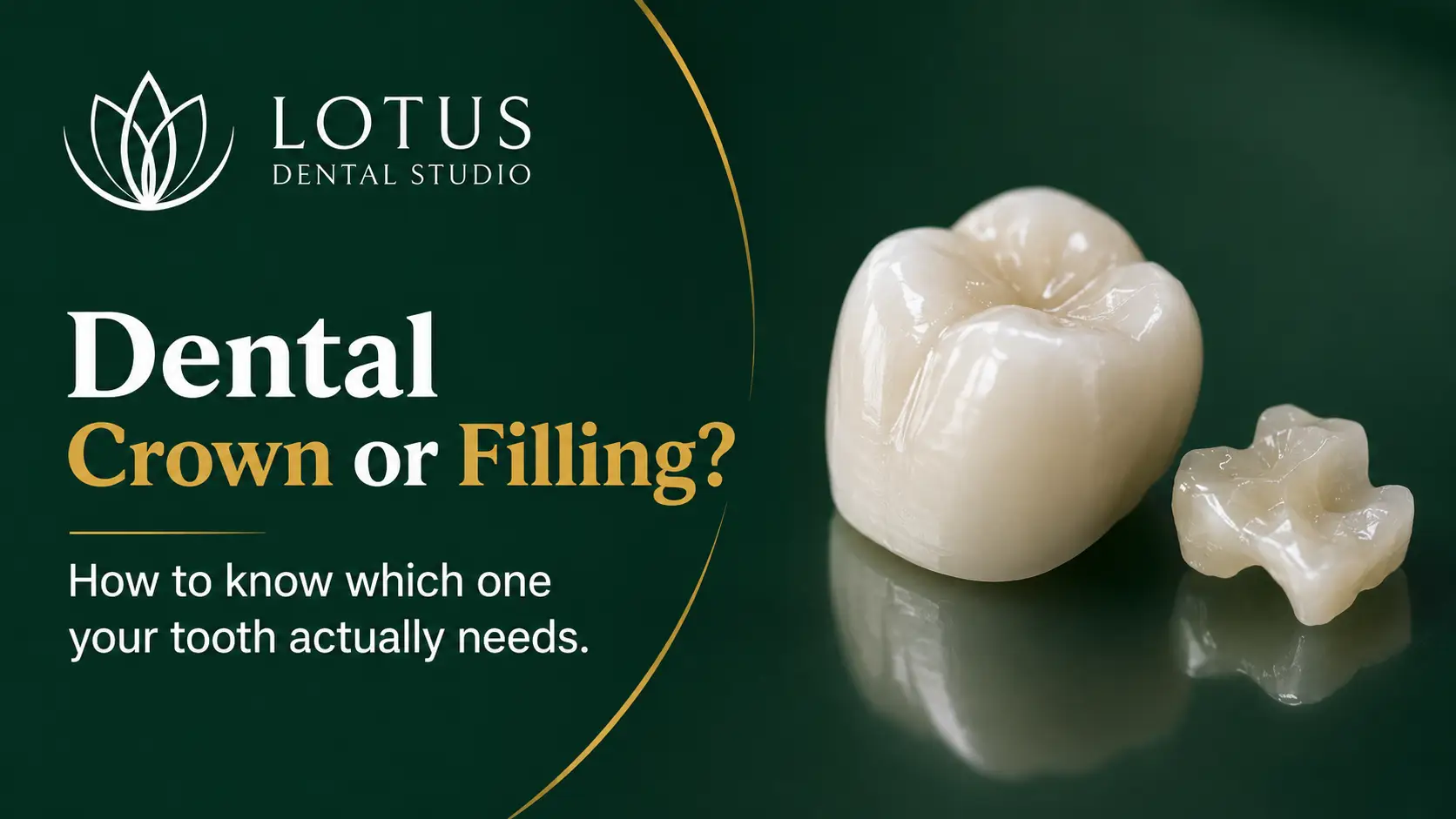 Featured image for dental crown or filling guide by Lotus Dental Studio in Llanelli South Wales