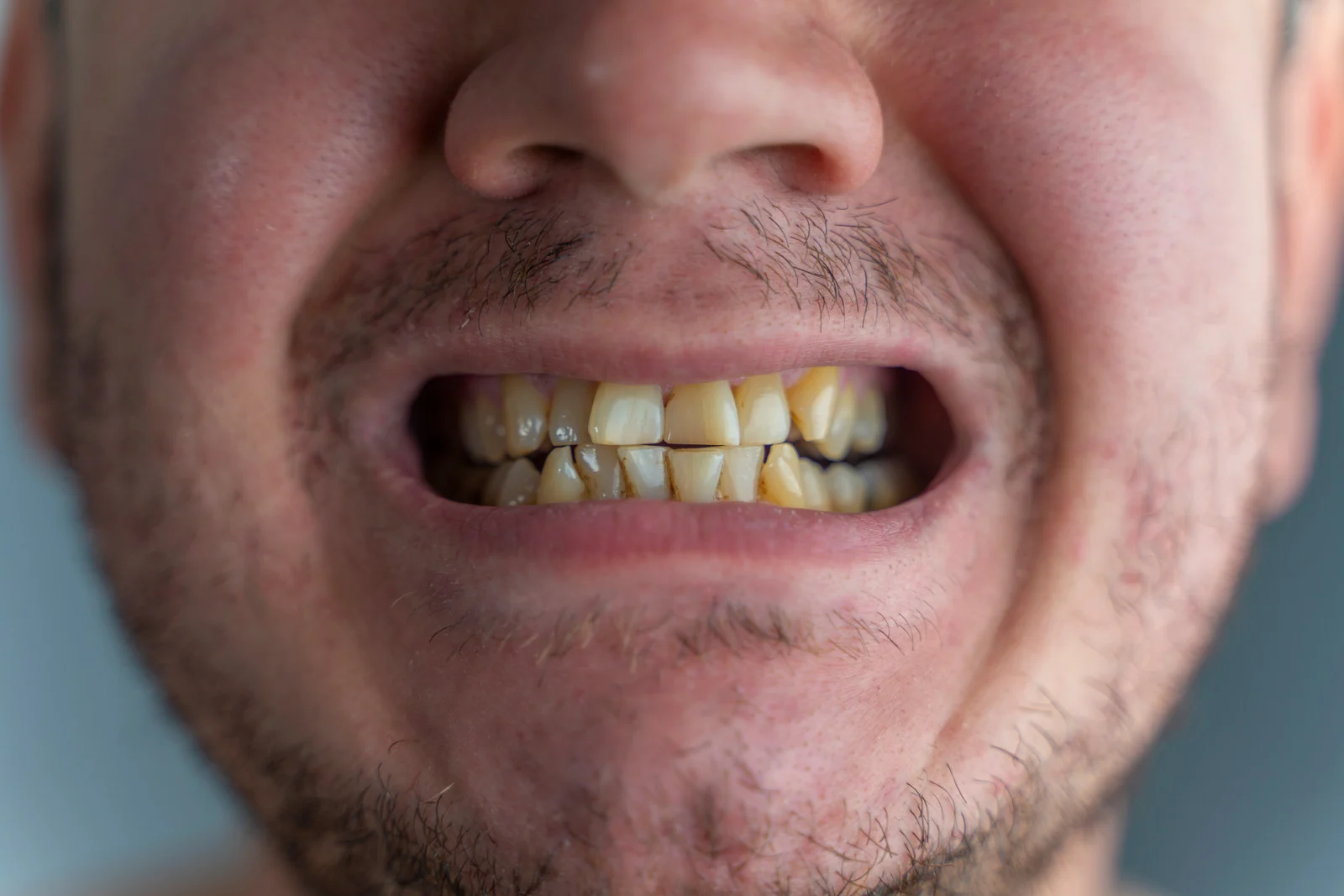 Close-up of stained, chipped and discoloured teeth that could be treated with porcelain veneers at Lotus Dental Studio, Llanelli