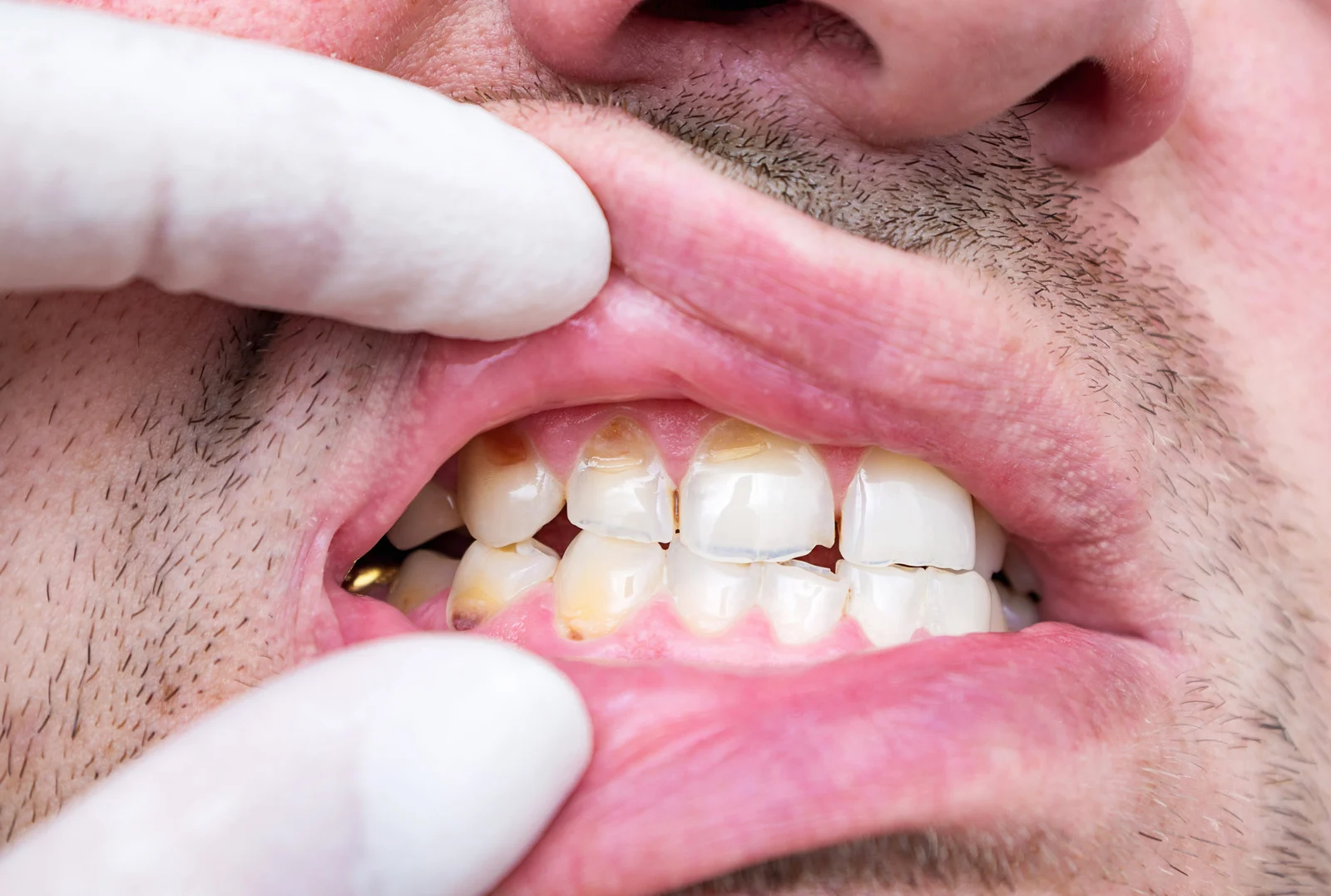 Dentist examining worn and discoloured teeth during a cosmetic consultation at Lotus Dental Studio, Llanelli