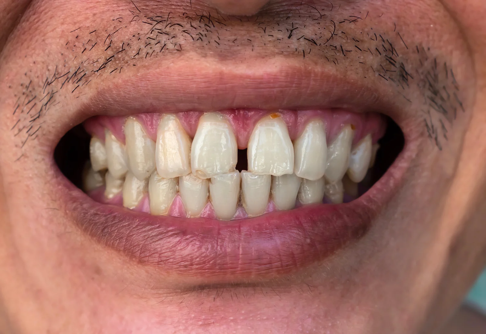 Close-up of a gap between front teeth that can be corrected with porcelain veneers at Lotus Dental Studio, Llanelli