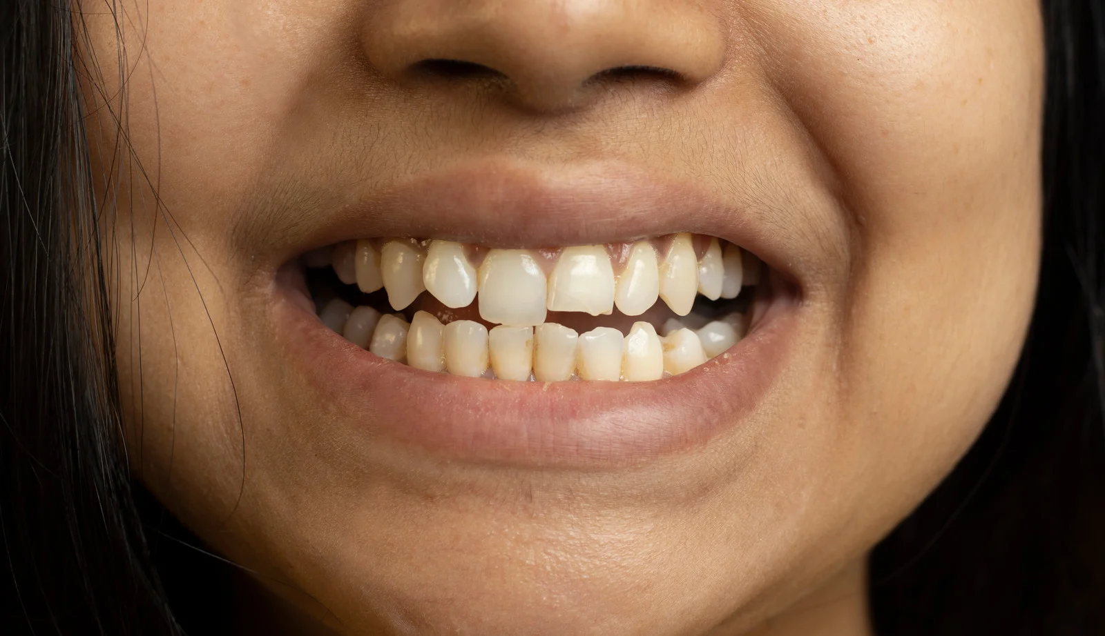 Close-up of uneven and misshapen teeth that can be improved with porcelain veneers at Lotus Dental Studio, Llanelli