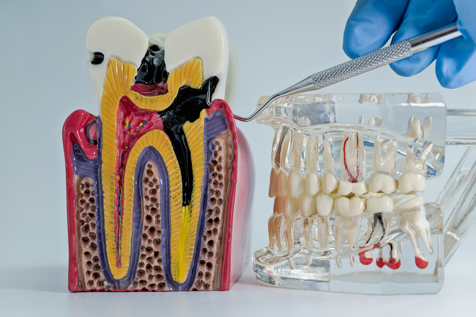 root canal models for root canal treatment in Llanelli UK