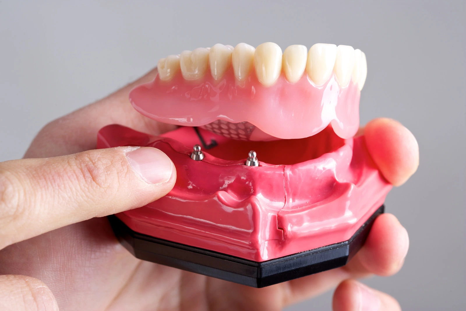 Model showing an implant-supported denture with attachment points, used to explain treatment options at Lotus Dental Studio