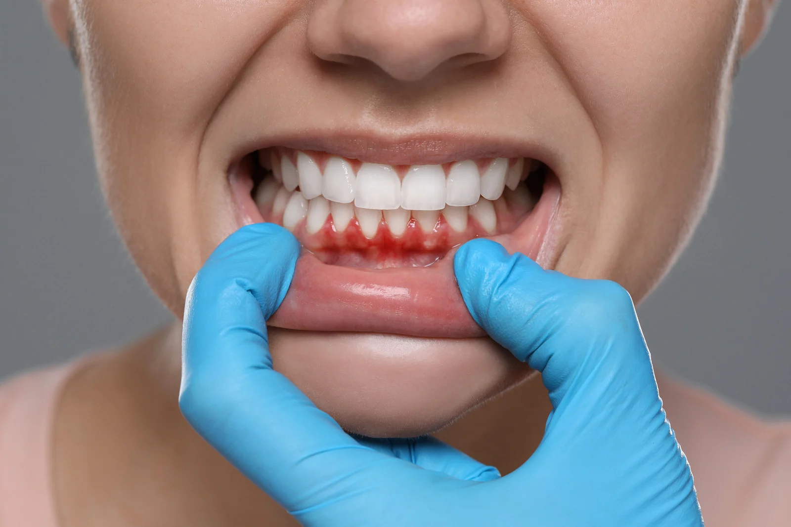 Dentist examining a patient's gums for early signs of gum disease which is Gingivitis at Lotus Dental Studio, Llanelli