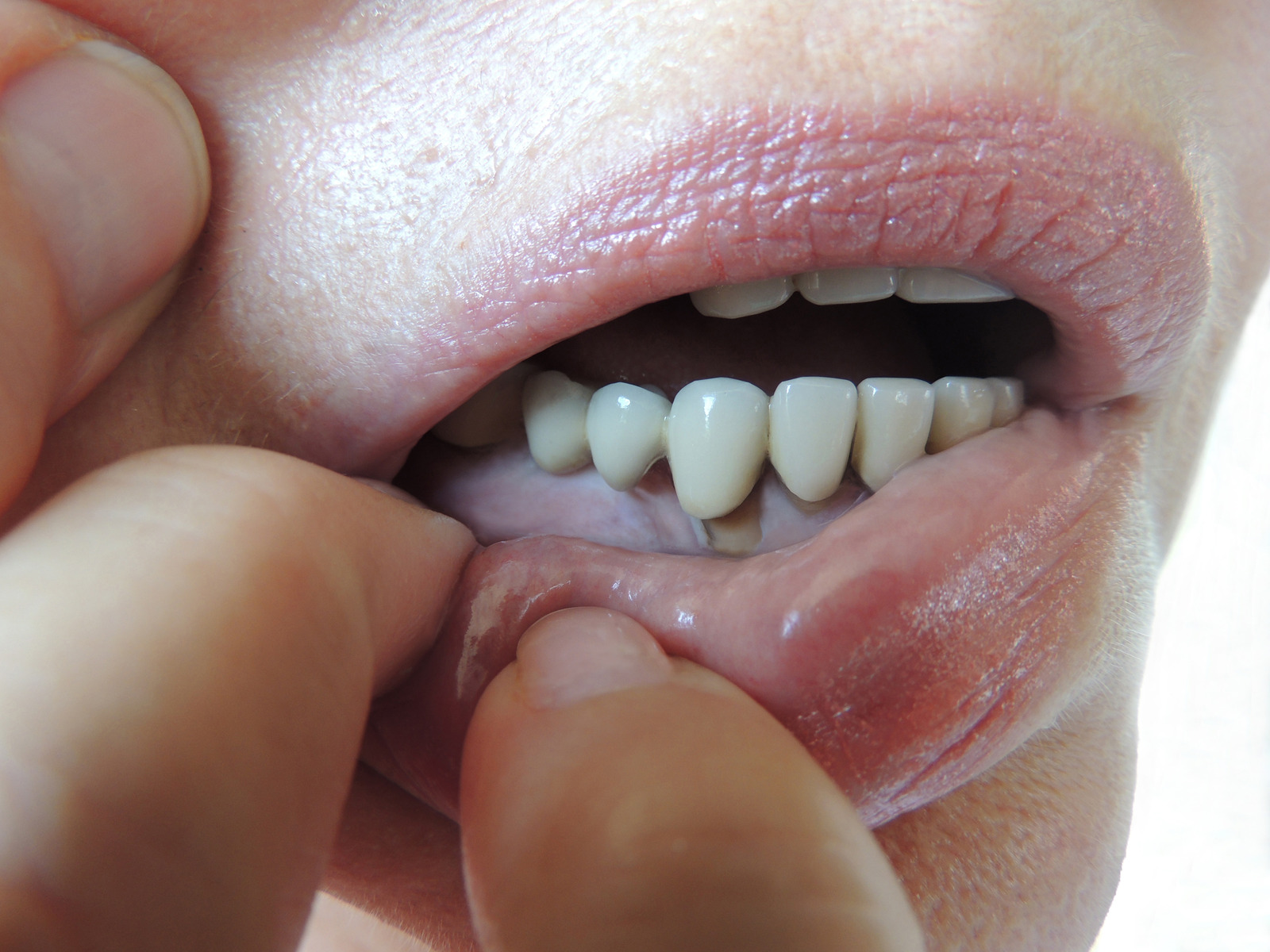 Example of gum recession and advanced periodontitis affecting the teeth and gumline