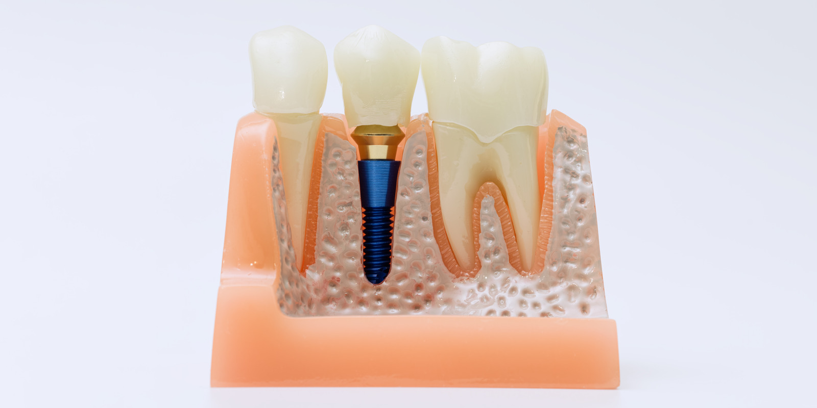Cross-section model of a dental implant showing the titanium post placed in the jawbone next to natural teeth