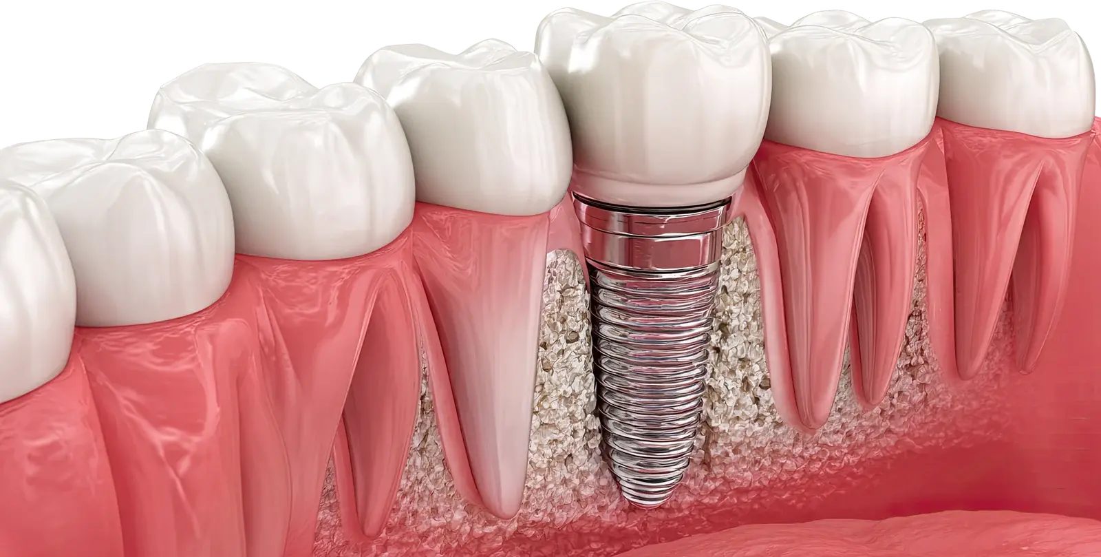 Cross-section diagram of a dental implant fused into the jawbone next to natural teeth