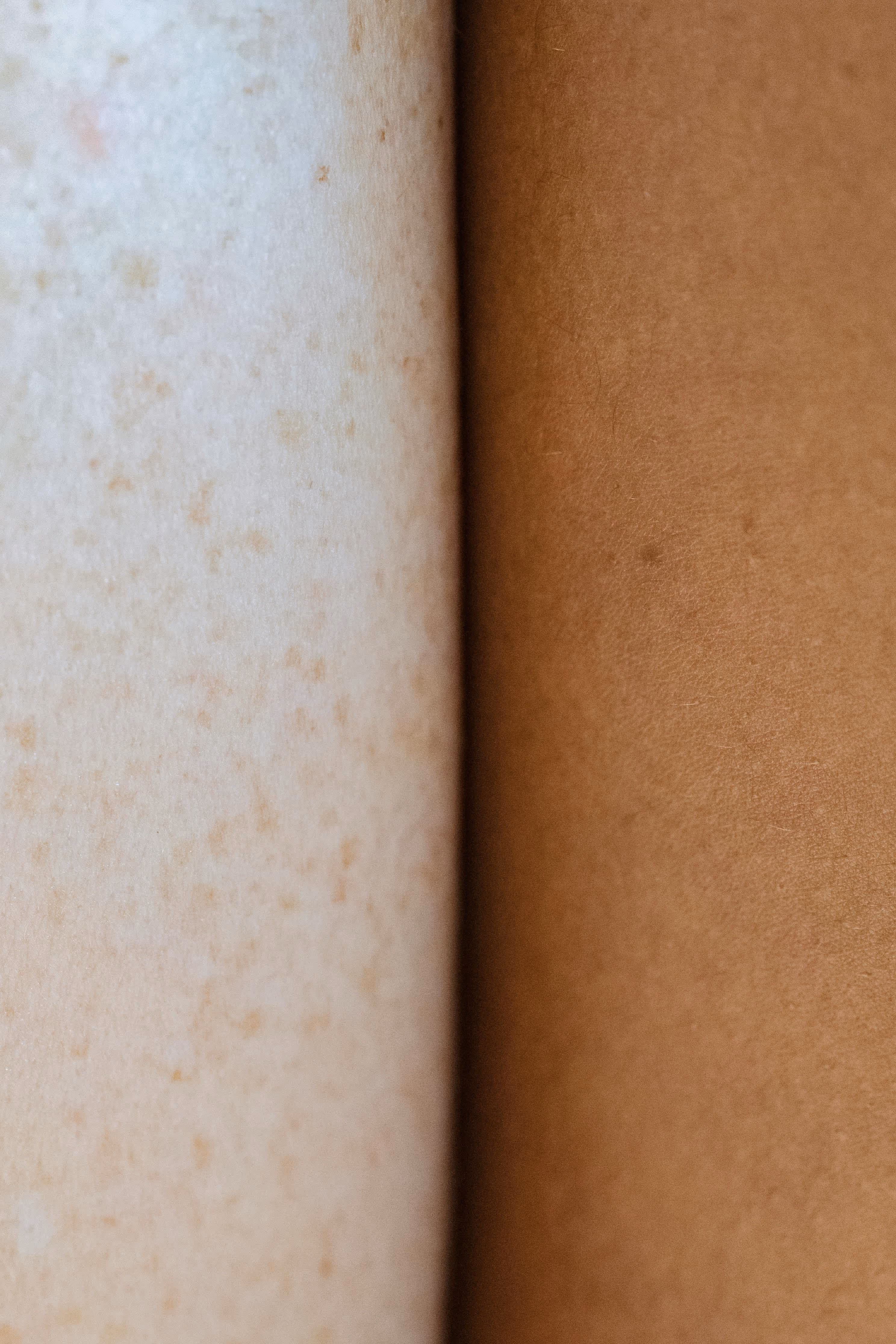 Uneven skin tone and texture