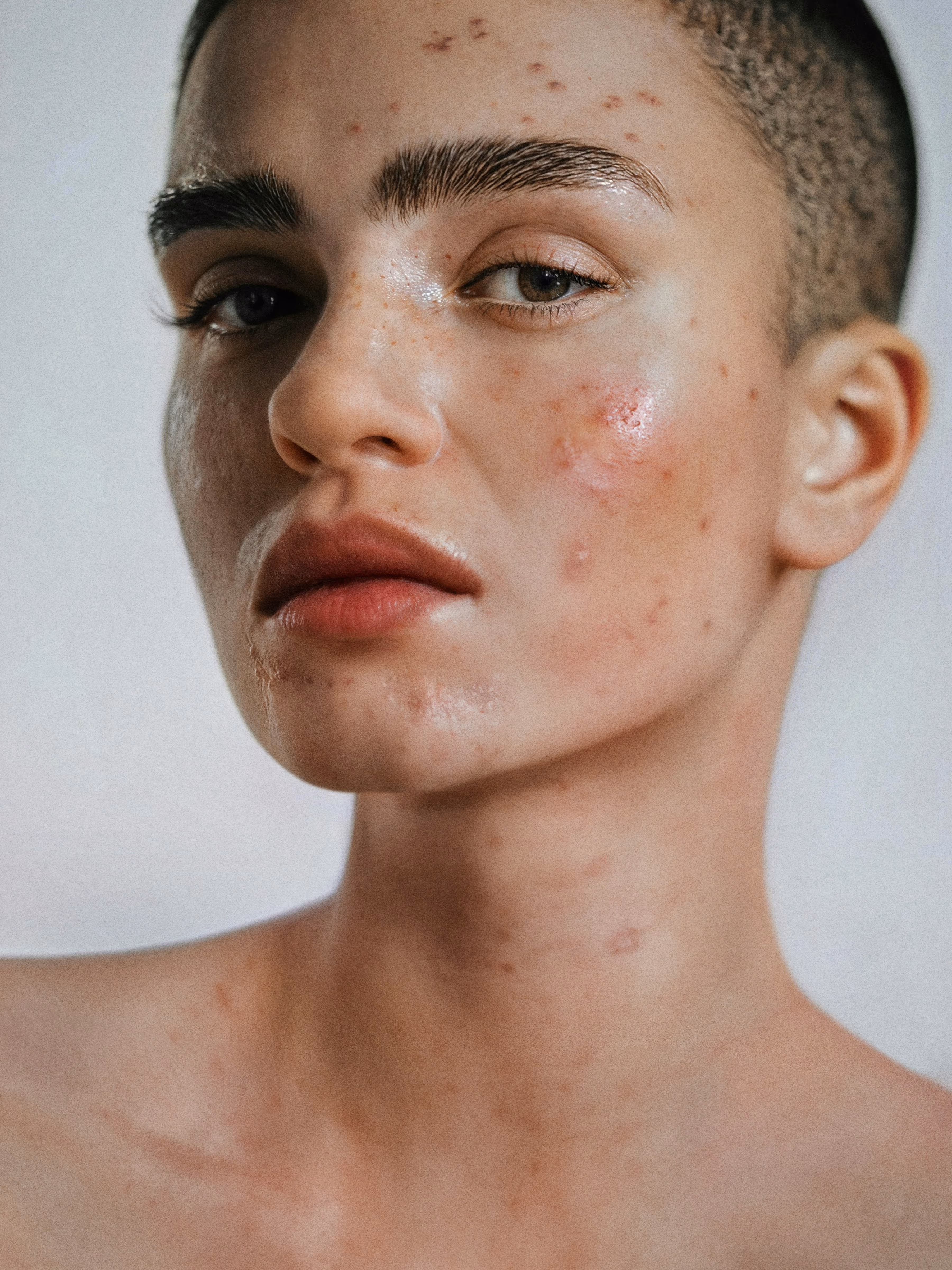 Acne scarring & post-inflammatory hyperpigmentation