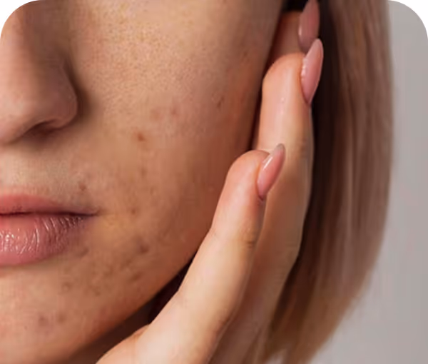 Acne scarring & post-inflammatory hyperpigmentation