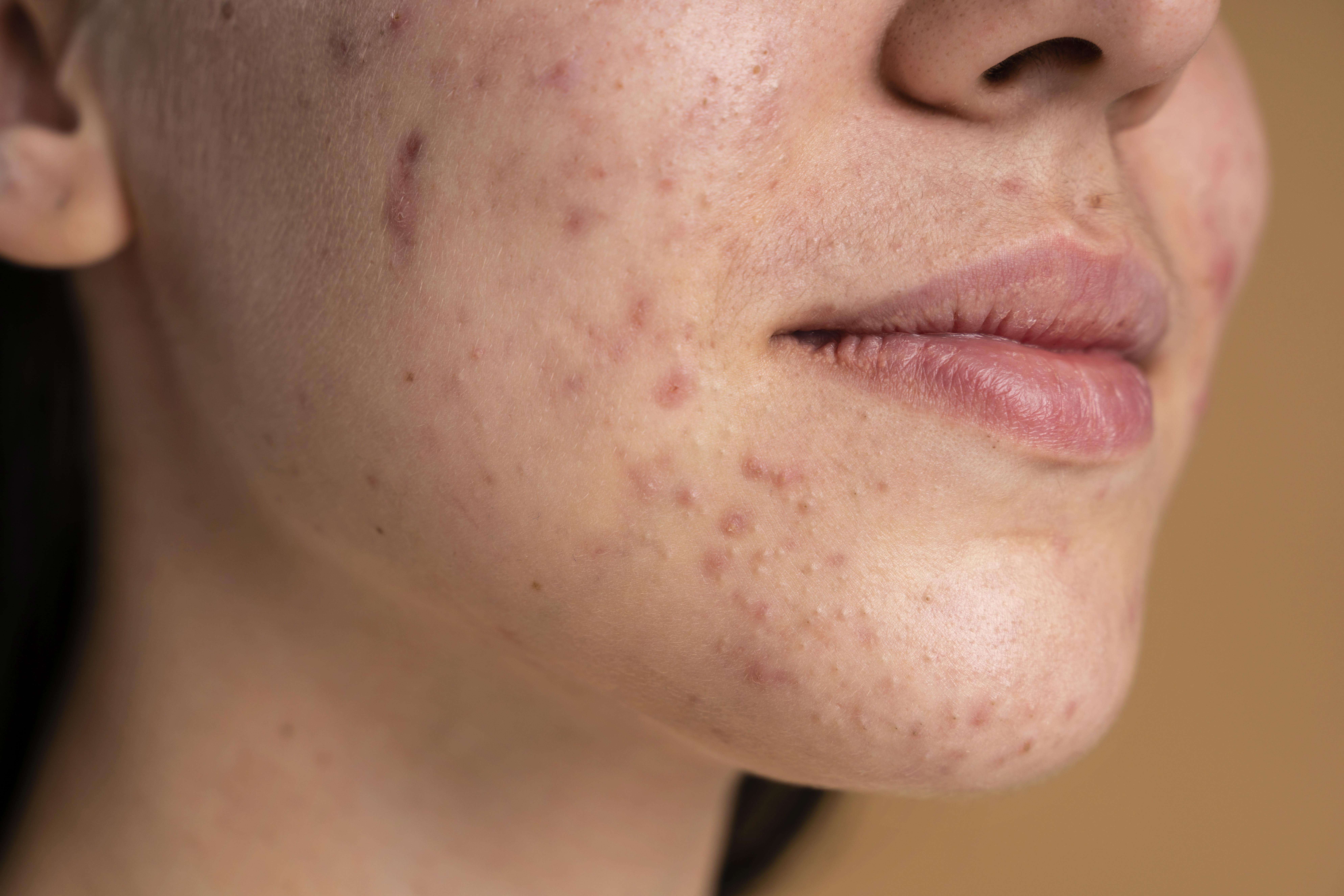 Inflammatory Acne