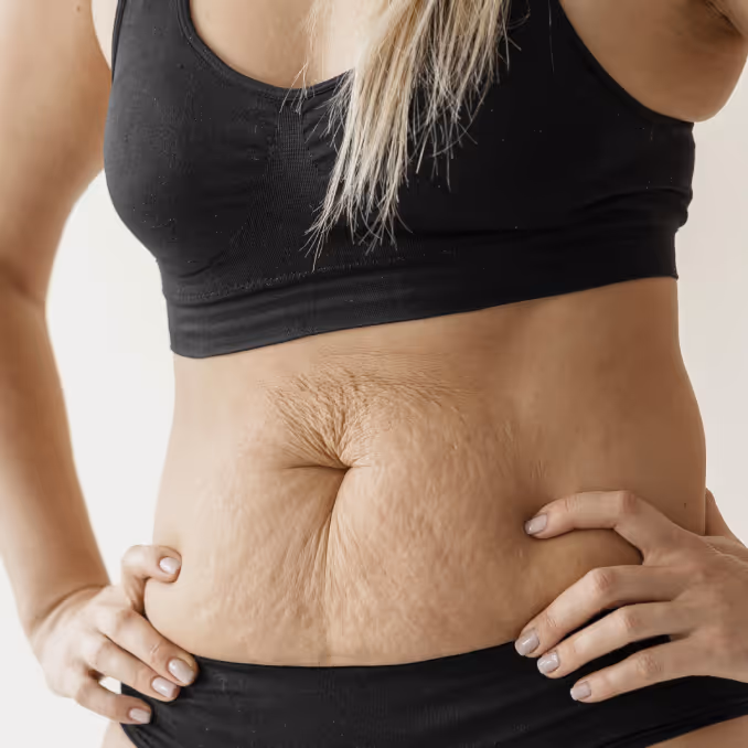 Acne scarring & post-inflammatory hyperpigmentation