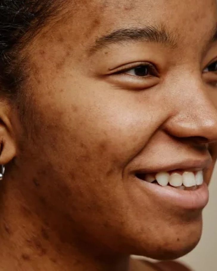 Scarring and texture irregularities