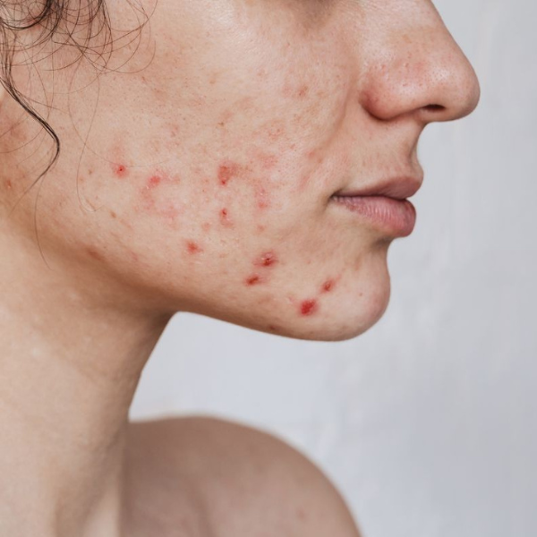 Redness and sensitivity