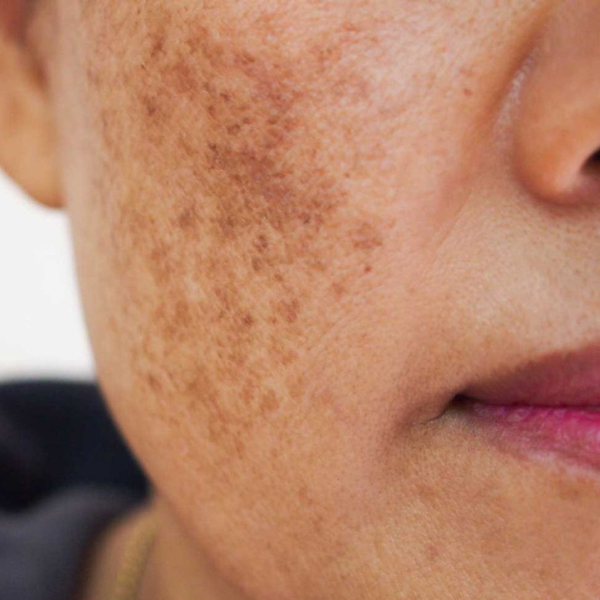 Fine lines and crepey texture