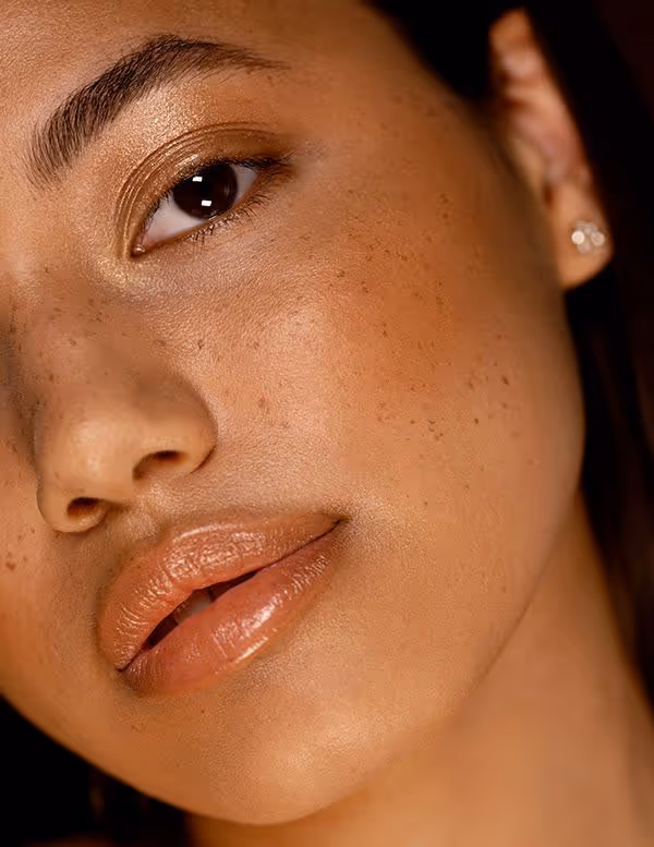 Acne scarring & post-inflammatory hyperpigmentation