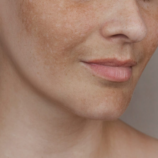 Melasma is a common skin condition characterized by discolored patches or dark spots on the face, most often appearing on the cheeks, forehead, and upper lip.